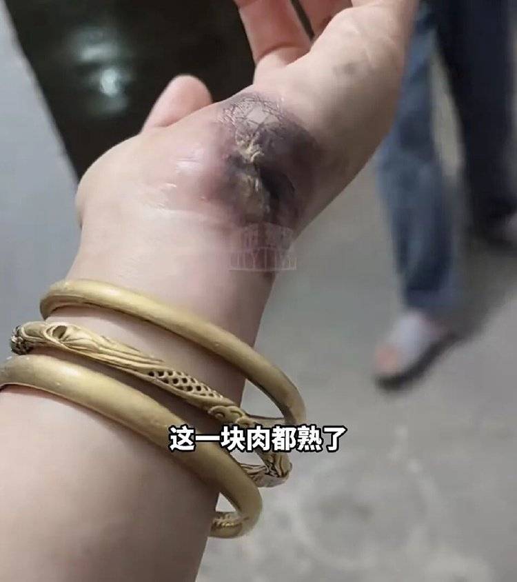 手被烧熟!金手镯被烧熔!女子给电动车充电,不慎碰到充电口受伤
